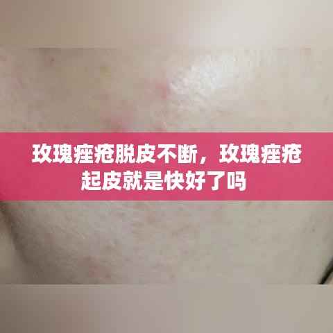 玫瑰痤疮脱皮不断,玫瑰痤疮起皮就是快好了吗